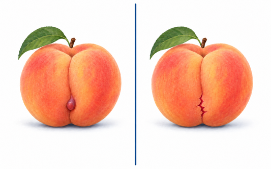 Hemorrhoids vs. Anal Fissures: Key Differences